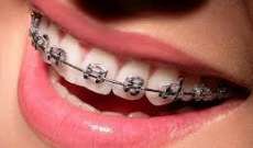 تقويم الأسنان من أهم علاجات طب الأسنان: التجميل بموازاة الحفاظ على صحة الفم