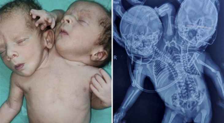 ولادة طفل برأسين وقلبين وثلاثة أذرع في الهند