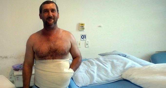 جراحون ينقذون يد برازيلي من البتر بخياطتها في بطنه