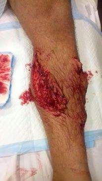 صياد يتعرض لعضة من سمكة قرش على شاطئ بلدة أنفة شمال لبنان