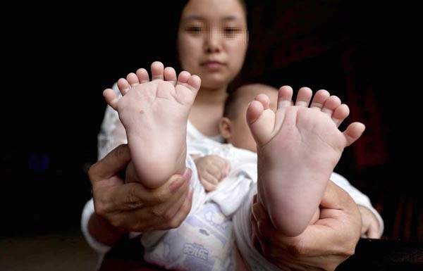 عائلة صينية ترزق بطفل ب 31 اصبعا