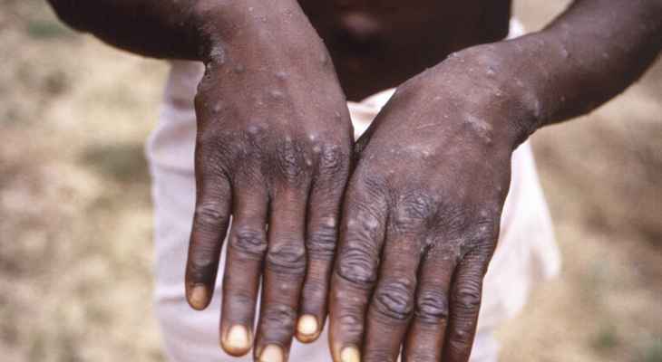 الصحة السودانية: تسجيل أول إصابة بجدري القردة في ولاية غرب دارفور
