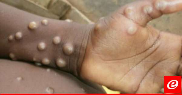 The US Food and Drug Administration has approved a new drug for the treatment of monkeypox.