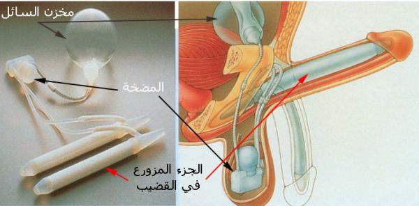 أسباب وطرق علاج العجز الجنسي عند الرجال مع الدكتور عماد غنطوس